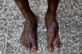 piedi con vistose ferite