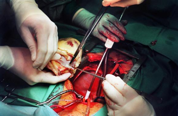 Un cuore in mano a un chirurgo poco prima di essere trapiantato nel nuovo corpo